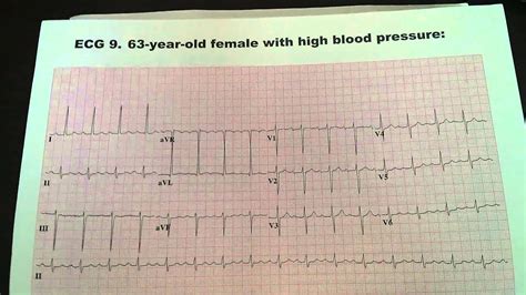 borderline ecg mayo clinic.